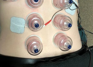 Cupping Therapy in Romeoville IL